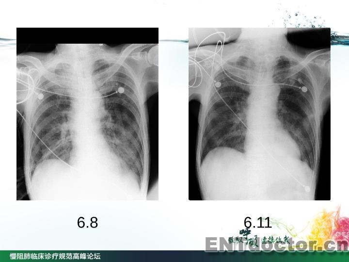 [回顾]慢阻肺临床诊疗规范病例分享